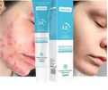 Gel Anti-Acnee cu Acid Salicilic – Curățare Profundă și Reducerea Imperfecțiunilor
