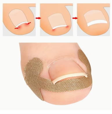 🔥 OFERTĂ 1+1 GRATUIT – Plasturi Corectori pentru Unghii Încarnate